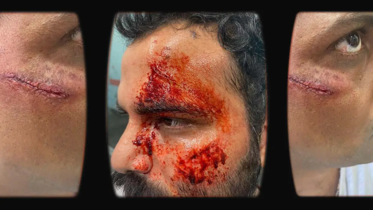 Prosthetic Work portfolio page 20